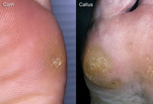 composite photo of corn and callus on foot Heloma Molle